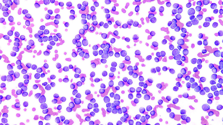 Uluru Escarpa enero Uso de los marcadores CD79a y CD3 en la tipificación inmunológica de  leucemia linfoblástica, secundaria al virus de leucemia viral felina |  Pérez Enriquez | Clínica veterinaria: abordaje diagnóstico y terapéutico